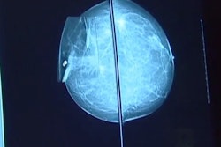 Mammograms contain highly predictive biomarkers of future cancer risk. A deep learning model using screening mammography alone can accurately discriminate patients at risk of developing DCIS and invasive disease across races, work at Massachusetts General Hospital suggests. Image and caption courtesy of RSNA.