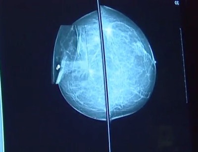 Mammograms contain highly predictive biomarkers of future cancer risk. A deep learning model using screening mammography alone can accurately discriminate patients at risk of developing DCIS and invasive disease across races, work at Massachusetts General Hospital suggests. Image and caption courtesy of RSNA.