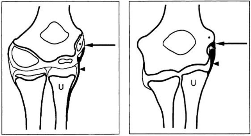Sketch of developing elbow, before and after growth plate closure. Image and caption courtesy of the RSNA.
