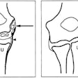 Sketch of developing elbow, before and after growth plate closure. Image and caption courtesy of the RSNA.