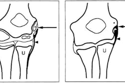 Sketch of developing elbow, before and after growth plate closure. Image and caption courtesy of the RSNA.
