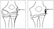 Sketch of developing elbow, before and after growth plate closure. Image and caption courtesy of the RSNA.