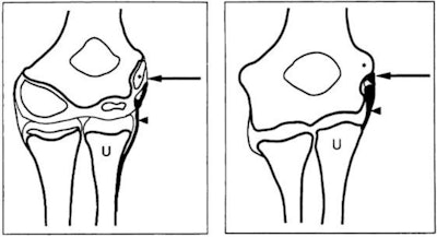 Sketch of developing elbow, before and after growth plate closure. Image and caption courtesy of the RSNA.