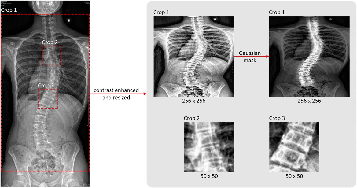 Three regions of interest (ROI) were selected and processed for training from each original radiograph. The leftmost image is the original coronal view radiograph. The original radiograph was passed through the CLAHE algorithm to enhance image brightness and contrast. The three crop boxes outlined by red dotted lines illustrate the three crops generated for model training. Crop 1 selects the ROI for the whole-spine region according to coordinates exported by AlignProCARE. Crops 2 and 3 select the ROIs for the upper and lower end vertebra of the major curvature. All ROIs were subsequently resized into 256 &times; 256 for Crop 1 and 50 &times; 50 for Crop 2 and 3. Crop 1 ROI was additionally multiplied by a Gaussian mask to amplify the signal of the vertebrae. Image courtesy of the Global Spine Journal.