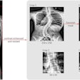 Three regions of interest (ROI) were selected and processed for training from each original radiograph. The leftmost image is the original coronal view radiograph. The original radiograph was passed through the CLAHE algorithm to enhance image brightness and contrast. The three crop boxes outlined by red dotted lines illustrate the three crops generated for model training. Crop 1 selects the ROI for the whole-spine region according to coordinates exported by AlignProCARE. Crops 2 and 3 select the ROIs for the upper and lower end vertebra of the major curvature. All ROIs were subsequently resized into 256 × 256 for Crop 1 and 50 × 50 for Crop 2 and 3. Crop 1 ROI was additionally multiplied by a Gaussian mask to amplify the signal of the vertebrae. Image courtesy of the Global Spine Journal.