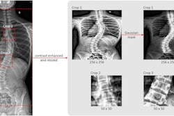 Three regions of interest (ROI) were selected and processed for training from each original radiograph. The leftmost image is the original coronal view radiograph. The original radiograph was passed through the CLAHE algorithm to enhance image brightness and contrast. The three crop boxes outlined by red dotted lines illustrate the three crops generated for model training. Crop 1 selects the ROI for the whole-spine region according to coordinates exported by AlignProCARE. Crops 2 and 3 select the ROIs for the upper and lower end vertebra of the major curvature. All ROIs were subsequently resized into 256 × 256 for Crop 1 and 50 × 50 for Crop 2 and 3. Crop 1 ROI was additionally multiplied by a Gaussian mask to amplify the signal of the vertebrae. Image courtesy of the Global Spine Journal.