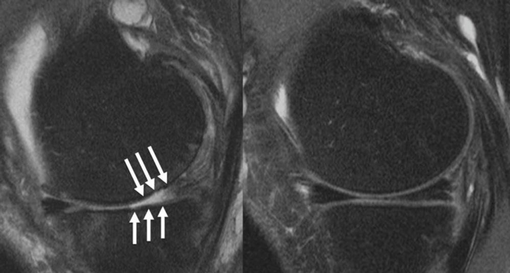 MRI images of a knee joint of a patient showing (left) severe cartilage defects compared to a patient with an intact knee joint. Image courtesy of Upadhyay Bharadwaj, MD