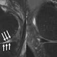MRI images of a knee joint of a patient showing (left) severe cartilage defects compared to a patient with an intact knee joint. Image courtesy of Upadhyay Bharadwaj, MD