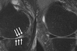 MRI images of a knee joint of a patient showing (left) severe cartilage defects compared to a patient with an intact knee joint. Image courtesy of Upadhyay Bharadwaj, MD