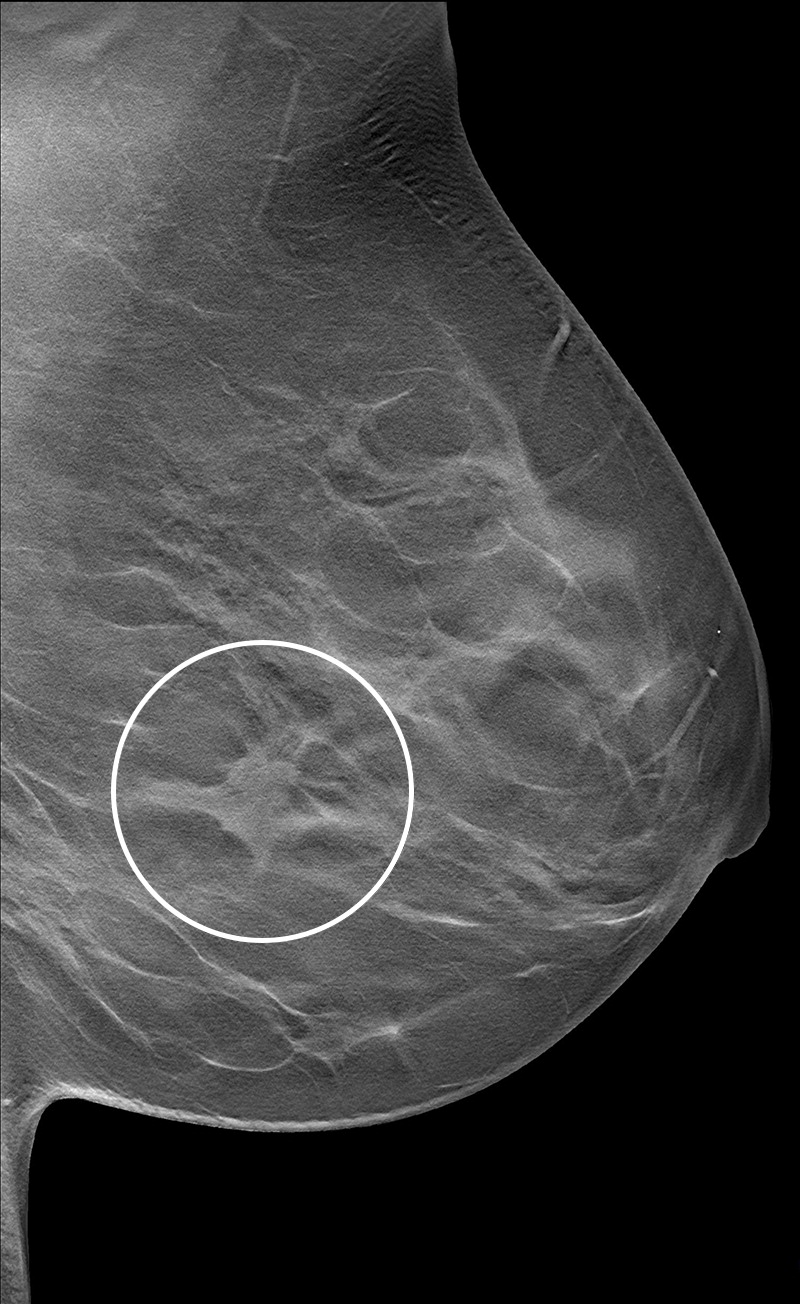 Imaging depicts a screen-detected invasive breast cancer in the dense breast tissue of a 59-year-old woman. A section in the mediolateral oblique view from a DBT exam of the left breast shows an irregular mass with surrounding architectural distortion (circle). The participant had no history of breast cancer and had been screened previously in the German mammography screening program. Histologic analysis showed invasive carcinoma of no special type, grade 2, with tumor size of 18 mm. Image courtesy of the RSNA.