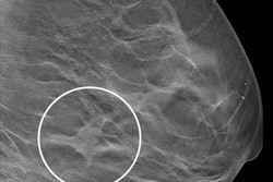 Imaging depicts a screen-detected invasive breast cancer in the dense breast tissue of a 59-year-old woman. A section in the mediolateral oblique view from a DBT exam of the left breast shows an irregular mass with surrounding architectural distortion (circle). The participant had no history of breast cancer and had been screened previously in the German mammography screening program. Histologic analysis showed invasive carcinoma of no special type, grade 2, with tumor size of 18 mm. Image courtesy of the RSNA.
