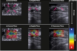 B-mode (a–c) and strain ratio (d–f) images of a carcinoma of unknown type in the coronal (a, d), sagittal (b, e) and transverse (c, f) planes. In the strain images (d–f), the maximal principal strain ratios are superimposed on the B-mode images of the top row. The purple arrows indicate the lesion. Image courtesy of Ultrasound in Medicine & Biology. Image available for fair use under creative commons license.