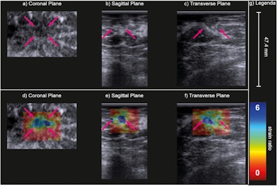 B-mode (a–c) and strain ratio (d–f) images of a carcinoma of unknown type in the coronal (a, d), sagittal (b, e) and transverse (c, f) planes. In the strain images (d–f), the maximal principal strain ratios are superimposed on the B-mode images of the top row. The purple arrows indicate the lesion. Image courtesy of Ultrasound in Medicine & Biology. Image available for fair use under creative commons license.