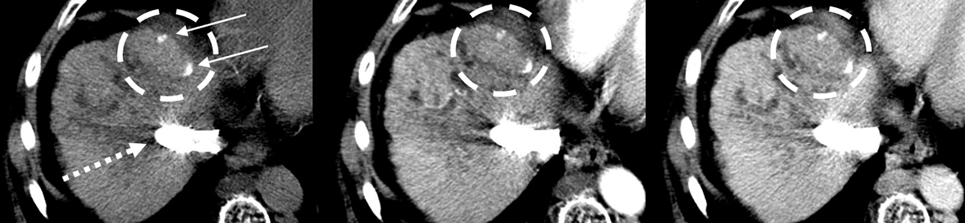 Images in a 55-year-old patient show hepatitis C-related cirrhosis and a transjugular intrahepatic portosystemic shunt (dashed arrow), with an undiagnosed tumor (dashed circle) at pretransplant imaging by both readers. Left: Noncontrast-enhanced axial CT image with a treated observation (dashed circles on the left, middle, and right images) and dense lipiodol staining (arrows) in the anterior right liver. Middle: Late arterial phase CT image with no appreciable enhancement. Right: Delayed phase image with no appreciable washout. The lesion was deemed at explant pathology to have 20% necrosis. Image courtesy of RSNA.