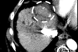 Images in a 55-year-old patient show hepatitis C-related cirrhosis and a transjugular intrahepatic portosystemic shunt (dashed arrow), with an undiagnosed tumor (dashed circle) at pretransplant imaging by both readers. Left: Noncontrast-enhanced axial CT image with a treated observation (dashed circles on the left, middle, and right images) and dense lipiodol staining (arrows) in the anterior right liver. Middle: Late arterial phase CT image with no appreciable enhancement. Right: Delayed phase image with no appreciable washout. The lesion was deemed at explant pathology to have 20% necrosis. Image courtesy of RSNA.
