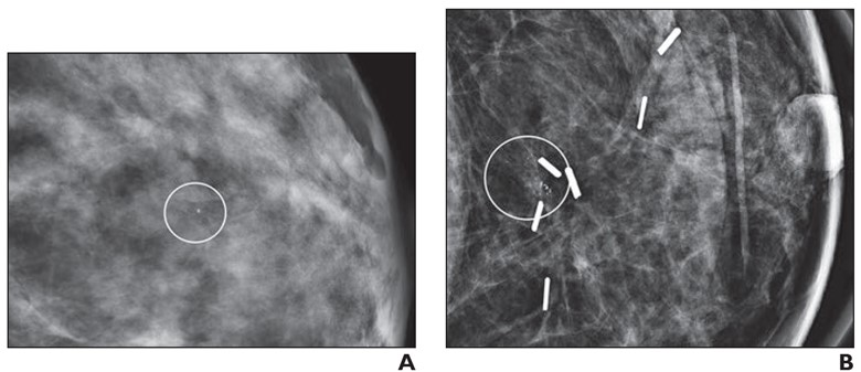 (A) Mammographic magnification view shows grouped calcifications in the left breast (circle). Stereotactic biopsy yielded grade 2 DCIS. Patient underwent a lumpectomy with tumor-negative surgical margins and radiation therapy. (B) Mammographic magnification view obtained four years after diagnosis shows new calcifications at the surgical site (circle). Stereotactic biopsy was performed, which revealed recurrent grade 2 DCIS. The patient then underwent a mastectomy. Image courtesy of the ARRS.