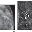 (A) Mammographic magnification view shows grouped calcifications in the left breast (circle). Stereotactic biopsy yielded grade 2 DCIS. Patient underwent a lumpectomy with tumor-negative surgical margins and radiation therapy. (B) Mammographic magnification view obtained four years after diagnosis shows new calcifications at the surgical site (circle). Stereotactic biopsy was performed, which revealed recurrent grade 2 DCIS. The patient then underwent a mastectomy. Image courtesy of the ARRS.