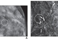 (A) Mammographic magnification view shows grouped calcifications in the left breast (circle). Stereotactic biopsy yielded grade 2 DCIS. Patient underwent a lumpectomy with tumor-negative surgical margins and radiation therapy. (B) Mammographic magnification view obtained four years after diagnosis shows new calcifications at the surgical site (circle). Stereotactic biopsy was performed, which revealed recurrent grade 2 DCIS. The patient then underwent a mastectomy. Image courtesy of the ARRS.