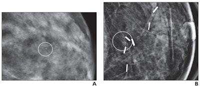 (A) Mammographic magnification view shows grouped calcifications in the left breast (circle). Stereotactic biopsy yielded grade 2 DCIS. Patient underwent a lumpectomy with tumor-negative surgical margins and radiation therapy. (B) Mammographic magnification view obtained four years after diagnosis shows new calcifications at the surgical site (circle). Stereotactic biopsy was performed, which revealed recurrent grade 2 DCIS. The patient then underwent a mastectomy. Image courtesy of the ARRS.