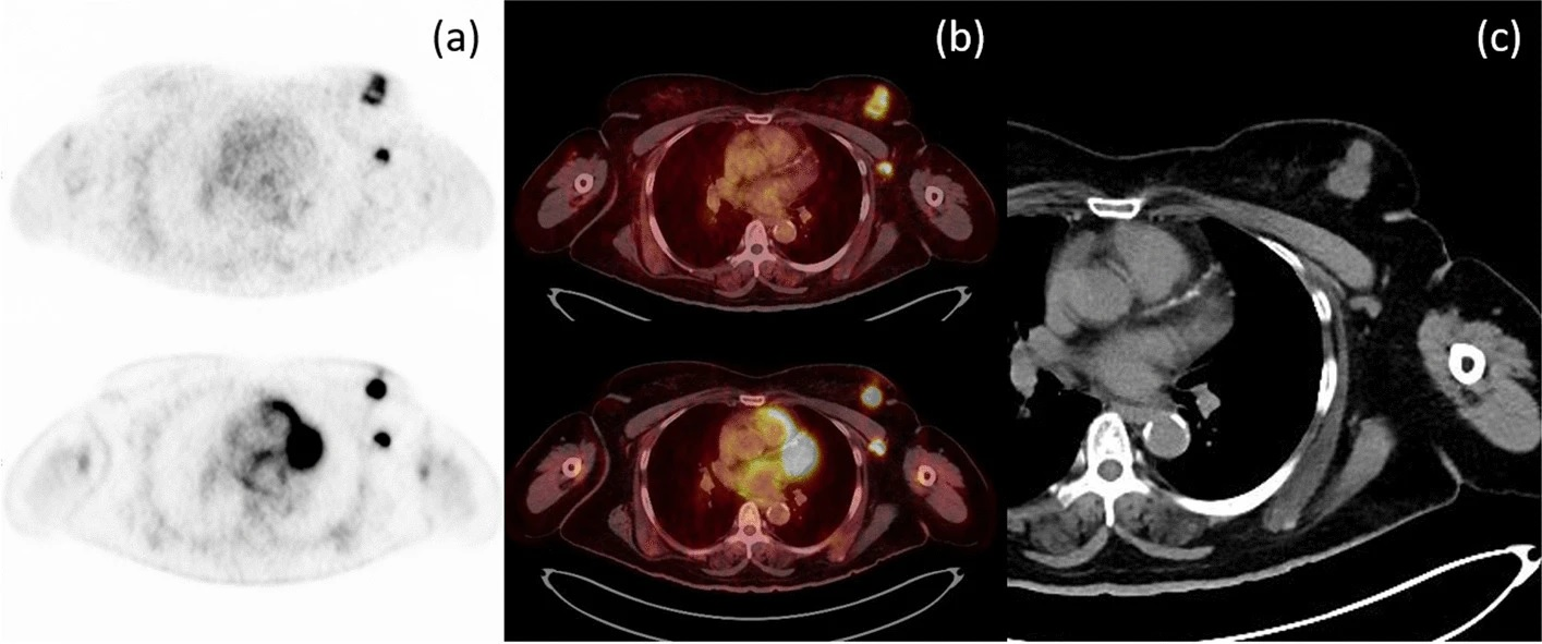 Axial PET (a) and axial fusion (b) images of F-18 FES (top) and F-18 FDG (bottom) with concordant uptake of both radiotracers in a left breast mass and left axillary node metastasis in correlation with CT imaging (c). Image courtesy of the European Journal of Hybrid Imaging.
