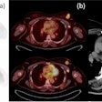 Axial PET (a) and axial fusion (b) images of F-18 FES (top) and F-18 FDG (bottom) with concordant uptake of both radiotracers in a left breast mass and left axillary node metastasis in correlation with CT imaging (c). Image courtesy of the European Journal of Hybrid Imaging.