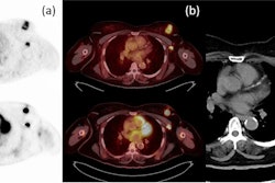 Axial PET (a) and axial fusion (b) images of F-18 FES (top) and F-18 FDG (bottom) with concordant uptake of both radiotracers in a left breast mass and left axillary node metastasis in correlation with CT imaging (c). Image courtesy of the European Journal of Hybrid Imaging.