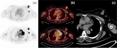 Axial PET (a) and axial fusion (b) images of F-18 FES (top) and F-18 FDG (bottom) with concordant uptake of both radiotracers in a left breast mass and left axillary node metastasis in correlation with CT imaging (c). Image courtesy of the European Journal of Hybrid Imaging.