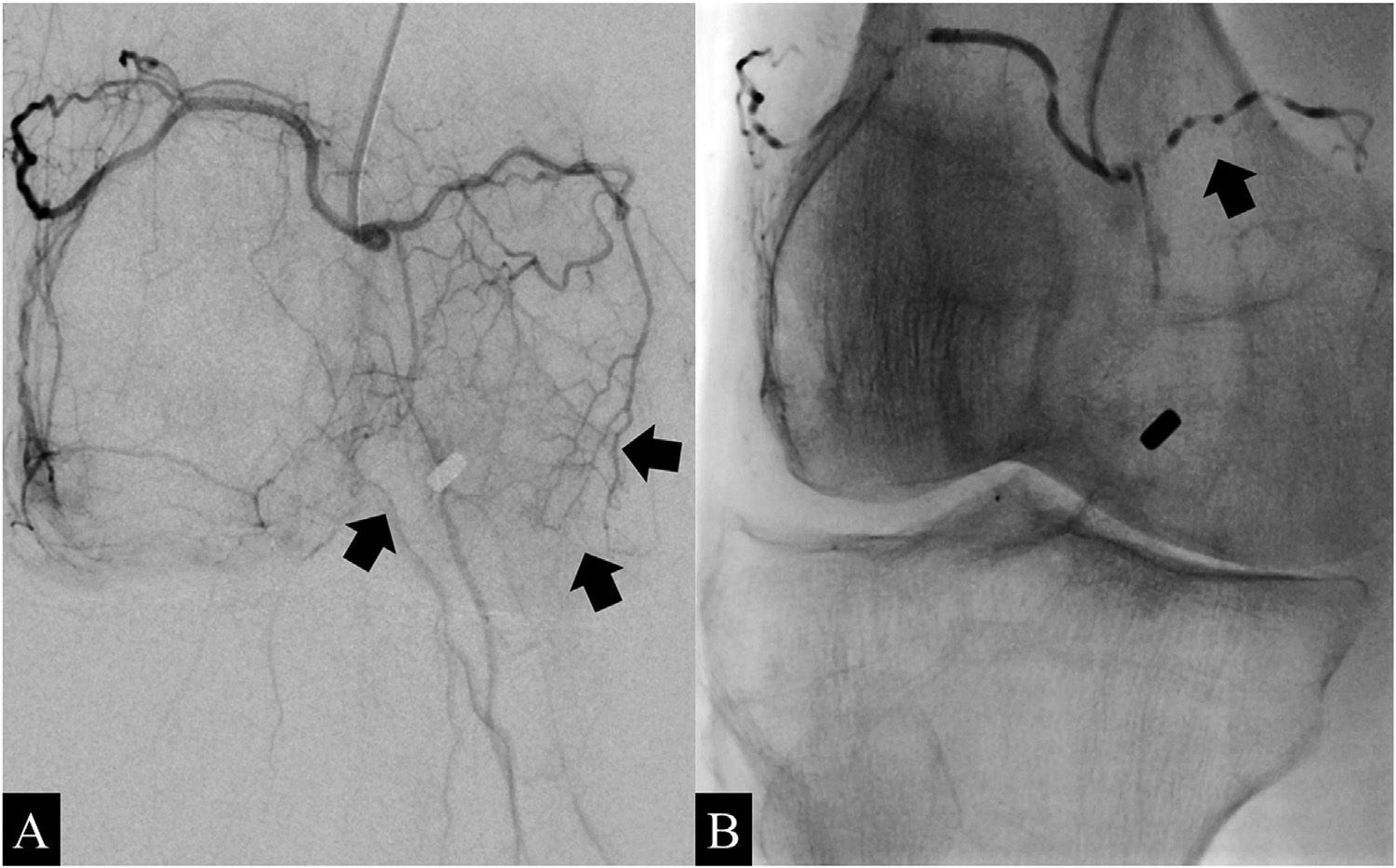 Angiograms of the right knee in a 76-year-old man with knee osteoarthritis. A) Before embolization, selective angiography of the common trunk of the superior lateral and superior medial genicular arteries shows hypervascular inflammatory blush (arrows). B) During embolization using ethiodized oil of the common trunk, the angiogram shows emulsion droplets (arrows). Image courtesy of Diagnostic and Interventional Imaging.