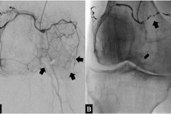 Angiograms of the right knee in a 76-year-old man with knee osteoarthritis. A) Before embolization, selective angiography of the common trunk of the superior lateral and superior medial genicular arteries shows hypervascular inflammatory blush (arrows). B) During embolization using ethiodized oil of the common trunk, the angiogram shows emulsion droplets (arrows). Image courtesy of Diagnostic and Interventional Imaging.