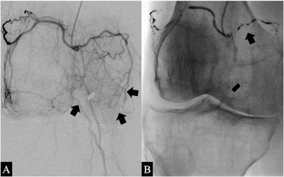 Angiograms of the right knee in a 76-year-old man with knee osteoarthritis. A) Before embolization, selective angiography of the common trunk of the superior lateral and superior medial genicular arteries shows hypervascular inflammatory blush (arrows). B) During embolization using ethiodized oil of the common trunk, the angiogram shows emulsion droplets (arrows). Image courtesy of Diagnostic and Interventional Imaging.