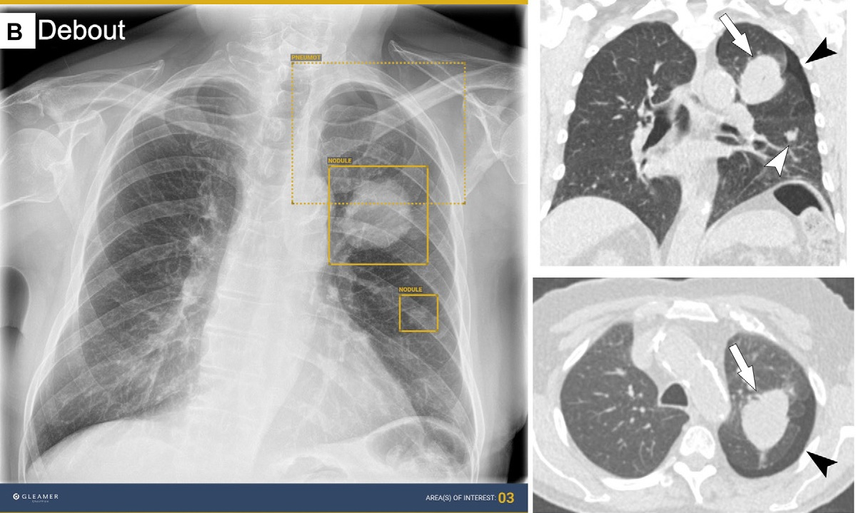 AI detected a lung mass, a lung nodule, and a small pneumothorax. Without AI assistance, only one thoracic radiologist and one general radiologist detected all abnormalities, whereas with AI assistance, one thoracic radiologist, two general radiologists, and one resident detected all abnormalities. Corresponding coronal and axial CT images show the lung mass (arrows), the lung nodule (white arrowheads), and the small pneumothorax (black arrowheads) that should have been detected on the chest radiograph. Image courtesy of Radiology.