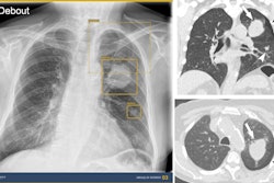 AI detected a lung mass, a lung nodule, and a small pneumothorax. Without AI assistance, only one thoracic radiologist and one general radiologist detected all abnormalities, whereas with AI assistance, one thoracic radiologist, two general radiologists, and one resident detected all abnormalities. Corresponding coronal and axial CT images show the lung mass (arrows), the lung nodule (white arrowheads), and the small pneumothorax (black arrowheads) that should have been detected on the chest radiograph. Image courtesy of Radiology.