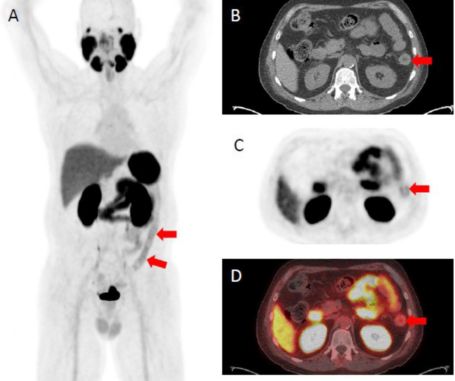 F-18 DCFPyL PET/CT demonstrating abnormally increased uptake in the descending colon (identified by red arrows), sigmoid colon, and rectum corresponding to findings on endoscopy. (A) F-18 DCFPyL PET/CT uptake in the descending colon on a coronal plane. (B) Axial CT image with arrows identifying active inflammation in the descending colon. (C) Axial PET imaging arrows identifying active inflammation in the descending colon. (D) Axial F-18 DCFPyL PET/CT fusion imaging identifying active inflammation in the descending colon. Image courtesy of Clinical and Experimental Gastroenterology.