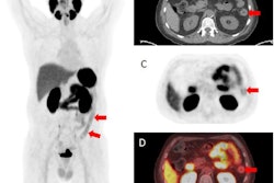 F-18 DCFPyL PET/CT demonstrating abnormally increased uptake in the descending colon (identified by red arrows), sigmoid colon, and rectum corresponding to findings on endoscopy. (A) F-18 DCFPyL PET/CT uptake in the descending colon on a coronal plane. (B) Axial CT image with arrows identifying active inflammation in the descending colon. (C) Axial PET imaging arrows identifying active inflammation in the descending colon. (D) Axial F-18 DCFPyL PET/CT fusion imaging identifying active inflammation in the descending colon. Image courtesy of Clinical and Experimental Gastroenterology.