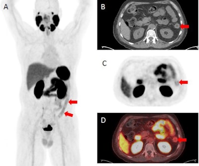 F-18 DCFPyL PET/CT demonstrating abnormally increased uptake in the descending colon (identified by red arrows), sigmoid colon, and rectum corresponding to findings on endoscopy. (A) F-18 DCFPyL PET/CT uptake in the descending colon on a coronal plane. (B) Axial CT image with arrows identifying active inflammation in the descending colon. (C) Axial PET imaging arrows identifying active inflammation in the descending colon. (D) Axial F-18 DCFPyL PET/CT fusion imaging identifying active inflammation in the descending colon. Image courtesy of Clinical and Experimental Gastroenterology.