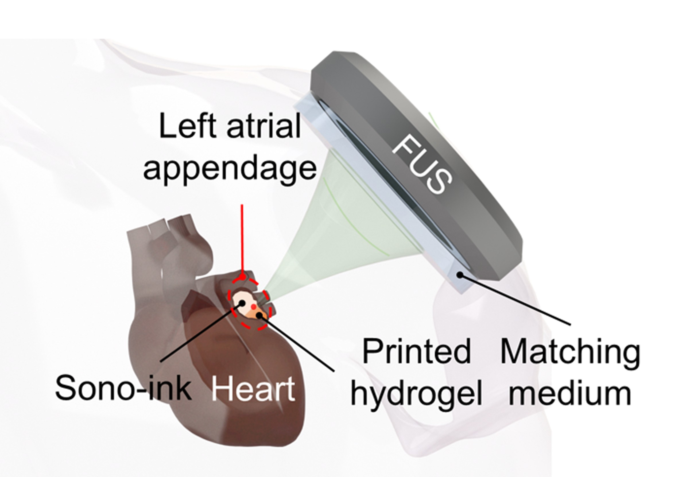 A scheme shows the minimally invasive left atrial appendage closure by delivering and solidifying sono-inks in the entire atrial appendage volume. Researchers highlighted the success of their deep-penetrating acoustic volumetric printing method, which uses focused ultrasound. Image courtesy of Xiao Kuang.