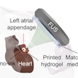 A scheme shows the minimally invasive left atrial appendage closure by delivering and solidifying sono-inks in the entire atrial appendage volume. Researchers highlighted the success of their deep-penetrating acoustic volumetric printing method, which uses focused ultrasound. Image courtesy of Xiao Kuang.