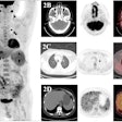 A 50-year-old man with recently diagnosed nasal-type NK/T-cell lymphoma underwent an F-18 FDG-PET/CT scan (A–D) for initial staging. Maximum-intensity-projection image (A) shows hypermetabolic lesions in both ethmoid sinus (thin arrow), both cervical lymphatic chains (arrowhead), left upper lung (thick arrow), liver, and spleen. Transaxial images show an F-18 FDG-avid mass in both ethmoid sinus (B). The scan shows intense F-18 FDG radiotracer uptake in left upper lung and uptake in the liver and spleen (CT showed no lesions), suggesting malignancy (C–D). Finally, after the PET/CT scan was done, the patient’s staging was changed from II to IV.