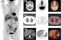 A 50-year-old man with recently diagnosed nasal-type NK/T-cell lymphoma underwent an F-18 FDG-PET/CT scan (A–D) for initial staging. Maximum-intensity-projection image (A) shows hypermetabolic lesions in both ethmoid sinus (thin arrow), both cervical lymphatic chains (arrowhead), left upper lung (thick arrow), liver, and spleen. Transaxial images show an F-18 FDG-avid mass in both ethmoid sinus (B). The scan shows intense F-18 FDG radiotracer uptake in left upper lung and uptake in the liver and spleen (CT showed no lesions), suggesting malignancy (C–D). Finally, after the PET/CT scan was done, the patient’s staging was changed from II to IV.