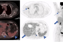 A 73-year-old woman with a suspicious lung nodule was referred to our division for F-18 FDG PET/CT exam. She was vaccinated four days before PET/CT. The lung nodule did not show any pathological FDG uptake; however, high tracer activity was detected on her right arm, where she was injected, and multiple hypermetabolic lymph nodes in the right axilla (arrows). Moreover, PET/CT showed high tracer activity in the liver (black arrows), spleen (triangular arrows), and bone marrow (small triangular arrows) as the result of systemic immune response after vaccination. The tracer defect in the liver was due to the known cyst. (A) fusion scan, (B) PET, (C) maximum intensity projection. Image courtesy of Scientific Reports.