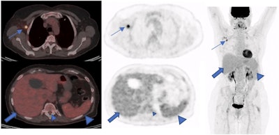 A 73-year-old woman with a suspicious lung nodule was referred to our division for F-18 FDG PET/CT exam. She was vaccinated four days before PET/CT. The lung nodule did not show any pathological FDG uptake; however, high tracer activity was detected on her right arm, where she was injected, and multiple hypermetabolic lymph nodes in the right axilla (arrows). Moreover, PET/CT showed high tracer activity in the liver (black arrows), spleen (triangular arrows), and bone marrow (small triangular arrows) as the result of systemic immune response after vaccination. The tracer defect in the liver was due to the known cyst. (A) fusion scan, (B) PET, (C) maximum intensity projection. Image courtesy of Scientific Reports.
