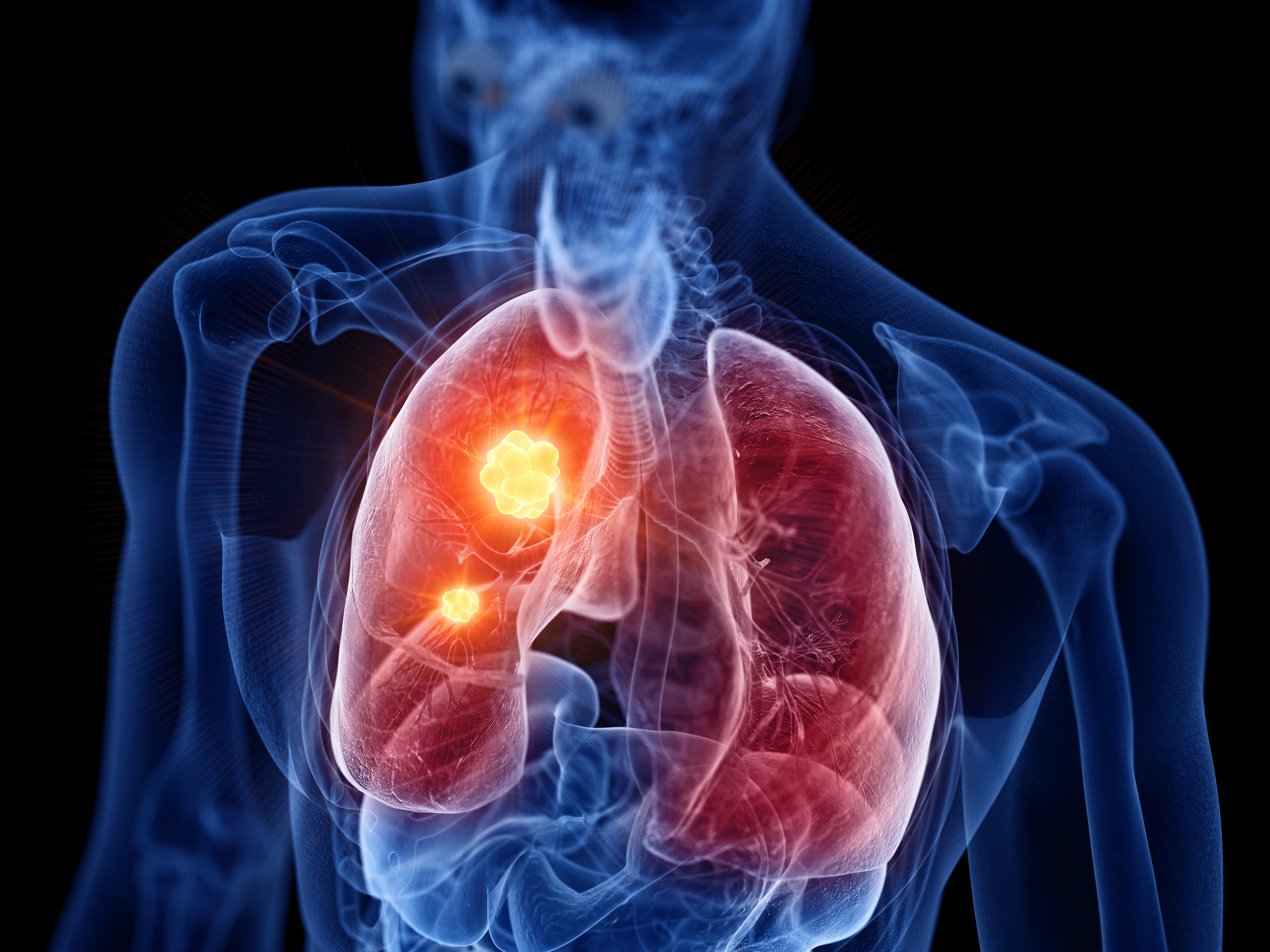 Lung Cancer Hotspot