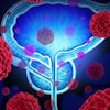 Prostate Cancer