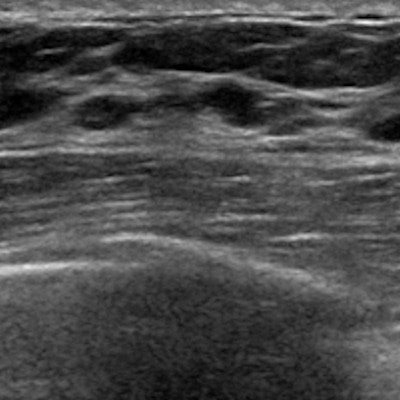 Ultrasound Breast 400