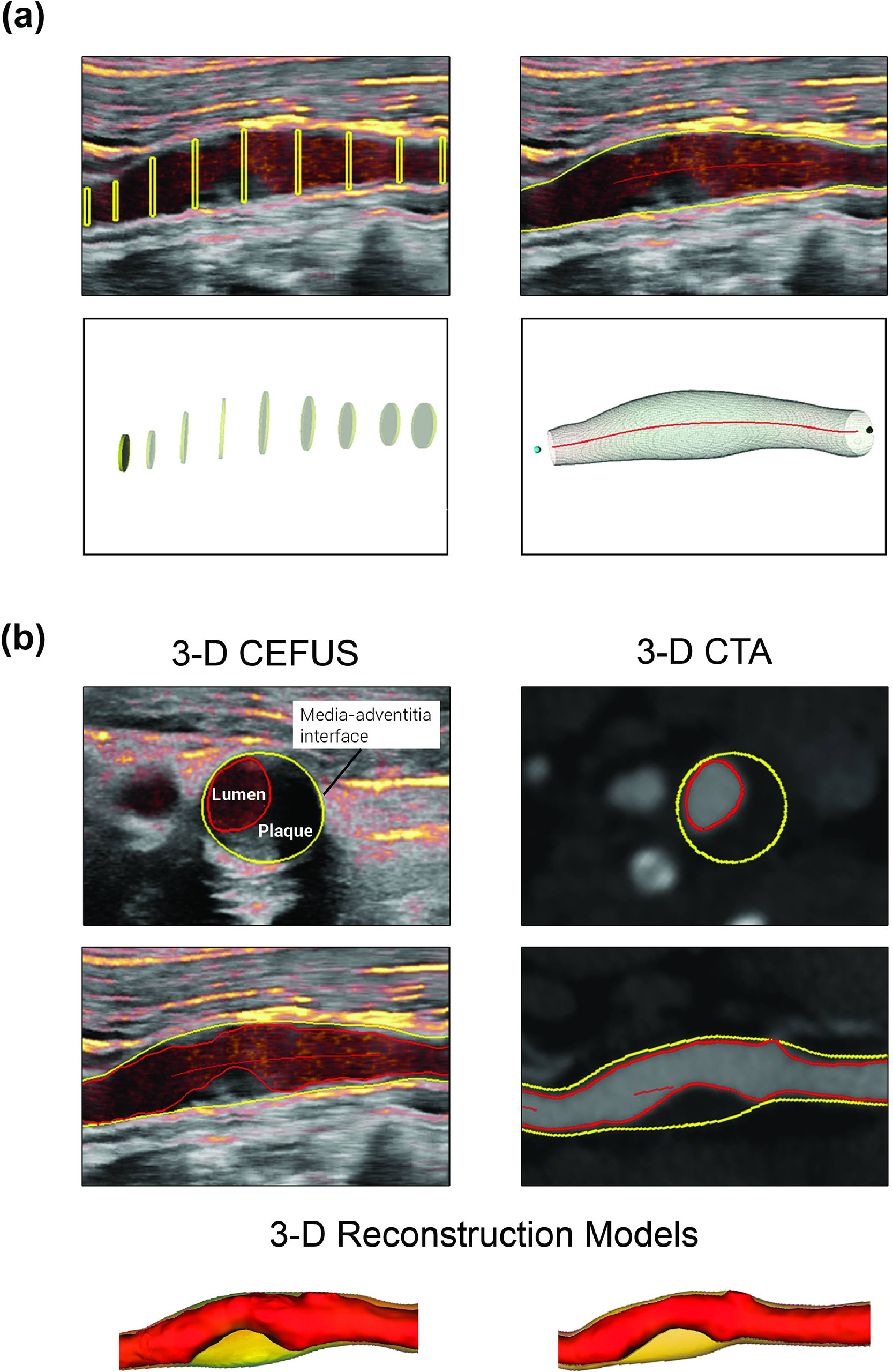 Segmentation of the carotid artery included the reconstruction of the carotid artery from 3D CEFUS/3D CTA to enable volume quantifications. (a) Only shown for 3D CEFUS, a 3D cylindrical model was initialized from manually set circle marks of the vessel wall border (media-adventitia interface) in the common carotid artery and internal carotid artery. From the circles, a mesh of the vessel border (yellow delineation) was formed. (b) The contour of the contrast-filled lumen was outlined (red delineation), creating a lumenography into the final reconstructed 3D carotid model. The same segmentation procedure was performed on the corresponding 3D CTA. The images are available to use under a Creative Commons license: CC BY 4.0 DEED, Attribution 4.0 International.
