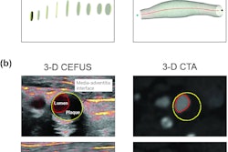 Segmentation of the carotid artery included the reconstruction of the carotid artery from 3D CEFUS/3D CTA to enable volume quantifications. (a) Only shown for 3D CEFUS, a 3D cylindrical model was initialized from manually set circle marks of the vessel wall border (media-adventitia interface) in the common carotid artery and internal carotid artery. From the circles, a mesh of the vessel border (yellow delineation) was formed. (b) The contour of the contrast-filled lumen was outlined (red delineation), creating a lumenography into the final reconstructed 3D carotid model. The same segmentation procedure was performed on the corresponding 3D CTA. The images are available to use under a Creative Commons license: CC BY 4.0 DEED, Attribution 4.0 International.