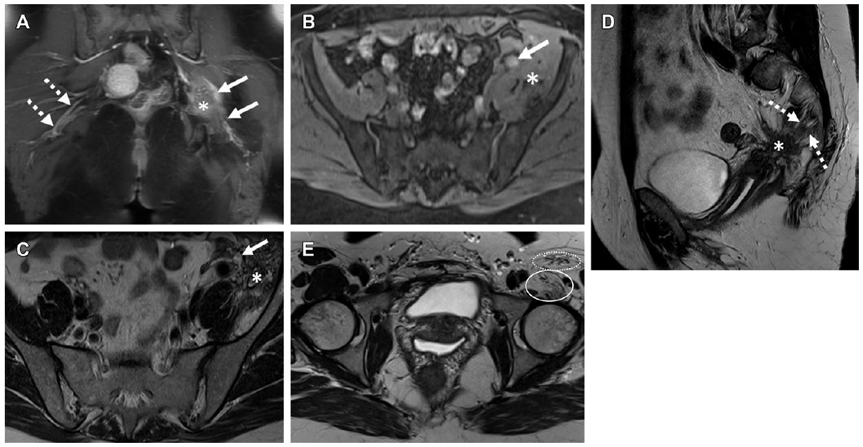 Spectrum of imaging features of nerves involved in endometriosis in three women. (A) Coronal T1W contrast-enhanced MR image in a 44-year-old woman shows a thickened left sciatic nerve with increased enhancement (solid arrows) and a fibrotic mass (*). The right-side sciatic nerve is normal in appearance (dashed arrows). (B-D) Axial T1W image (without contrast enhancement) with fat saturation (B) in a 43-year-old woman shows a cystic endometriotic lesion with signal hyperintensity (arrow in B). The adjacent left iliacus muscle is asymmetrically thickened due to involvement by endometriosis (* in B). Axial T2-weighted MR image (C) at the same level as B shows T2 shading in the cystic lesion (arrow in C) and a fibrotic mass replacing the iliacus muscle (* in C). Sagittal T2-weighted MR image (D) shows the sacral nerve roots (dashed arrows in D) encased by a fibrotic endometriotic mass (* in D). (E) Axial T2-weighted MR image in a 37-year-old woman shows atrophy of the left iliopsoas (solid oval) and sartorius muscles (dashed oval), both innervated by the femoral nerve. Images and caption courtesy of the RSNA.