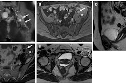 Spectrum of imaging features of nerves involved in endometriosis in three women. (A) Coronal T1W contrast-enhanced MR image in a 44-year-old woman shows a thickened left sciatic nerve with increased enhancement (solid arrows) and a fibrotic mass (*). The right-side sciatic nerve is normal in appearance (dashed arrows). (B-D) Axial T1W image (without contrast enhancement) with fat saturation (B) in a 43-year-old woman shows a cystic endometriotic lesion with signal hyperintensity (arrow in B). The adjacent left iliacus muscle is asymmetrically thickened due to involvement by endometriosis (* in B). Axial T2-weighted MR image (C) at the same level as B shows T2 shading in the cystic lesion (arrow in C) and a fibrotic mass replacing the iliacus muscle (* in C). Sagittal T2-weighted MR image (D) shows the sacral nerve roots (dashed arrows in D) encased by a fibrotic endometriotic mass (* in D). (E) Axial T2-weighted MR image in a 37-year-old woman shows atrophy of the left iliopsoas (solid oval) and sartorius muscles (dashed oval), both innervated by the femoral nerve. Images and caption courtesy of the RSNA.