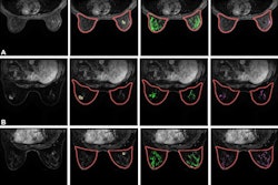 Examples of quantification of background parenchymal enhancement (BPE) over fibroglandular tissue (FGT) on breast DCE-MRI scans from three patients. Images from left to right are the first postcontrast T1-weighted images, automated segmentation of the right and left breasts (red contours) and semiautomated tumor segmentation (yellow), automated segmentation of FGT (green), and quantification of BPE (purple) over the FGT regions. (A) Images of a 48-year-old woman diagnosed with invasive ductal carcinoma and assigned a low-risk Oncotype DX distant recurrence risk score (score, 13). The BPE measures at 20% cutoff value were ipsilateral absolute BPE within FGT relative to FGT volume (%BPEF/F) of 9.8% and contralateral %BPEF/F of 9.5%. (B) Images of a 60-year-old woman diagnosed with invasive ductal carcinoma and assigned an intermediate-risk Oncotype DX distant recurrence risk score (score, 19). The BPE measures at 20% cutoff value were as follows: ipsilateral %BPEF/F of 13.3% and contralateral %BPEF/F of 14.7%. (C) Images of a 54-year-old woman diagnosed with invasive ductal carcinoma and assigned a high-risk Oncotype DX distant recurrence risk score (score, 30). The BPE measures at 20% cutoff value were as follows: ipsilateral %BPEF/F of 34.1% and contralateral %BPEF/F of 14.5%. Image courtesy of the RSNA.