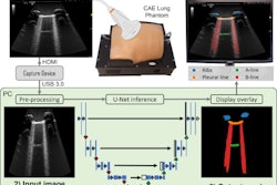 Workflow diagram showing real-time lung ultrasound segmentation with U-Net. Images available for republishing under Creative Commons license (CC BY 4.0 DEED, Attribution 4.0 International) and courtesy of Ultrasonics.